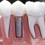 implantes dentales